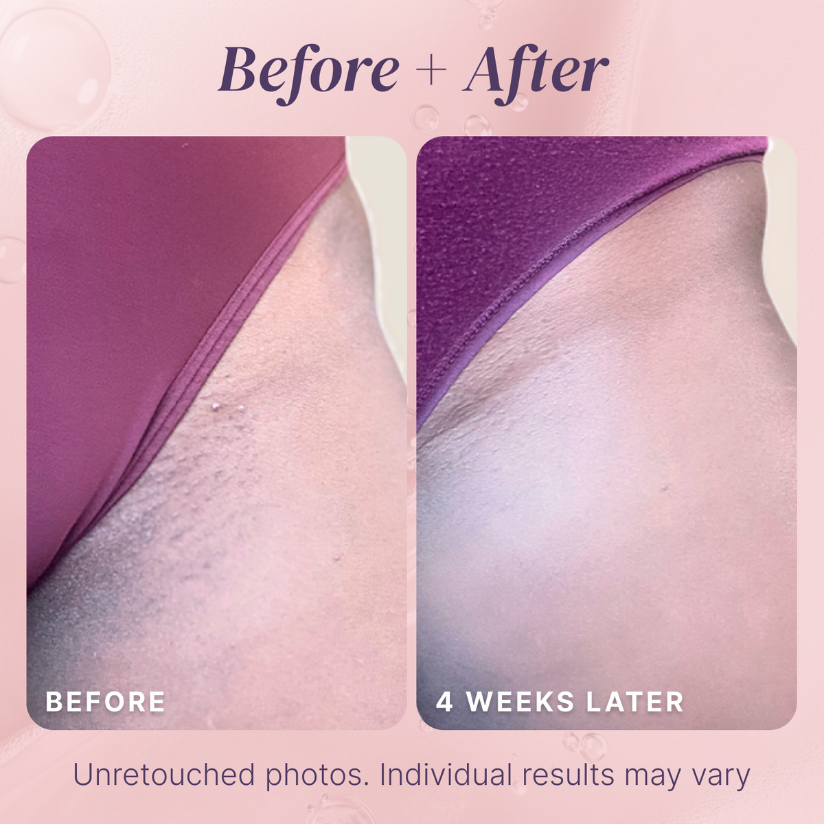 Brand-provided four-week bikini-area before-and-after photos; individual results may vary