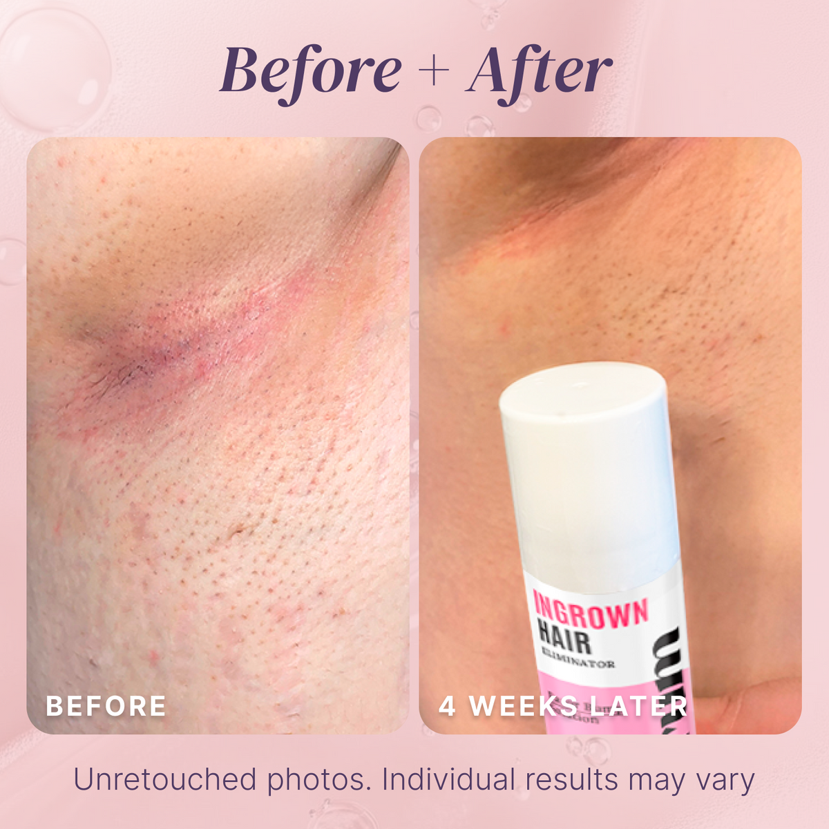 Brand-provided four-week underarm before-and-after photos; individual results may vary