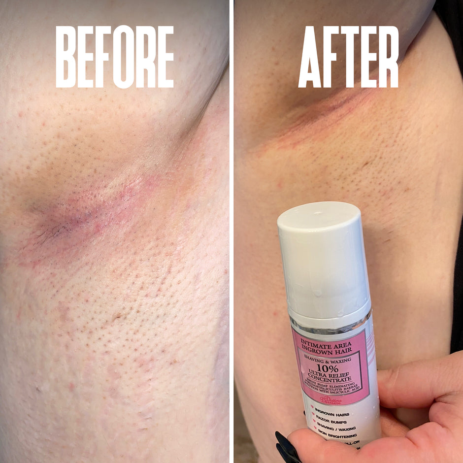Combat Angry Ingrown Hair, Dark Spots, Pfb Razor Bumps and Razor Burns ...